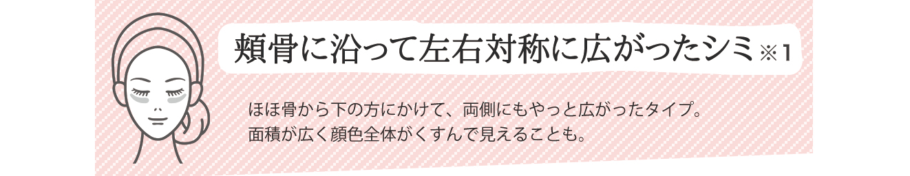 頬骨に沿って左右対称に広がったシミ